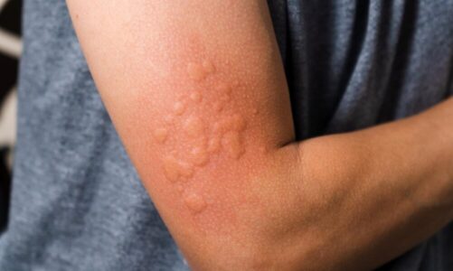 Czy półpasiec sam przejdzie?